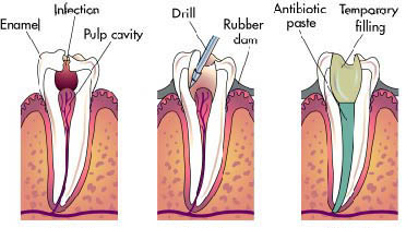 tooth nerve