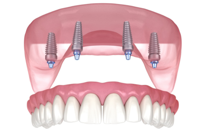 ALL- ON- 4- Denture Implant