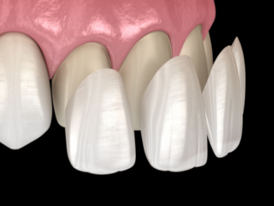 Dental Veneers