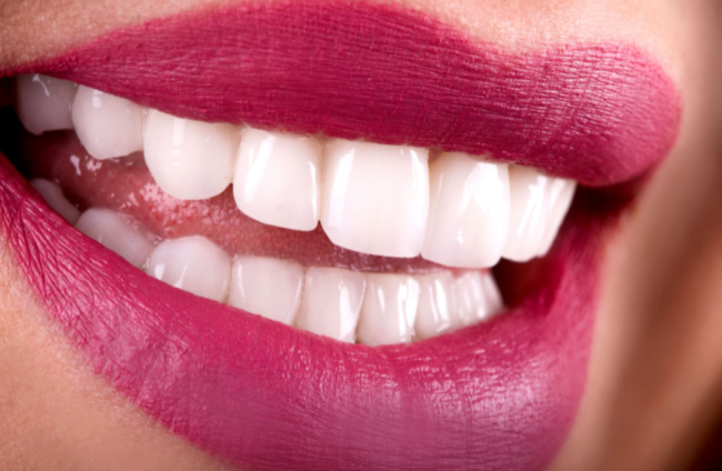 Should I Get Porcelain Veneers?