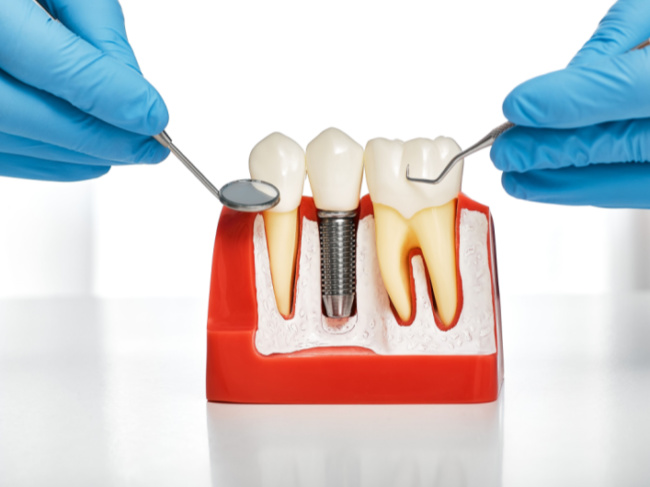 What are Dental Implants?