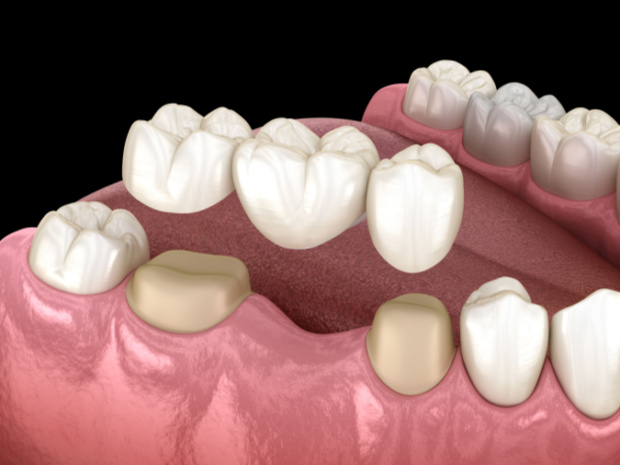 Dental Bridges