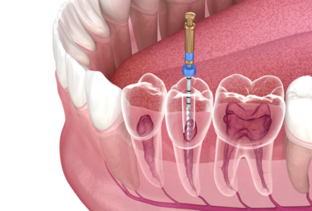 Root canal therapy