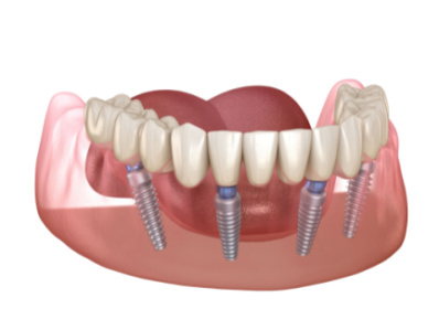 ALL-ON-4-Implants