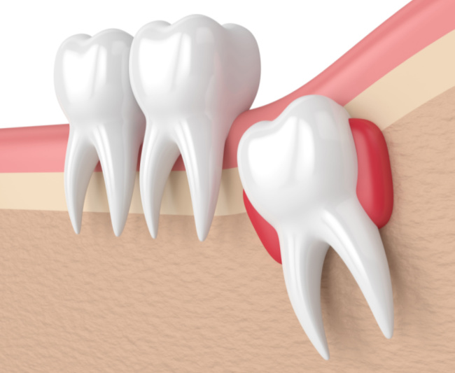 Prevent Formation of Cysts