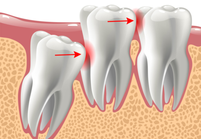 Prevent Teeth Crowding