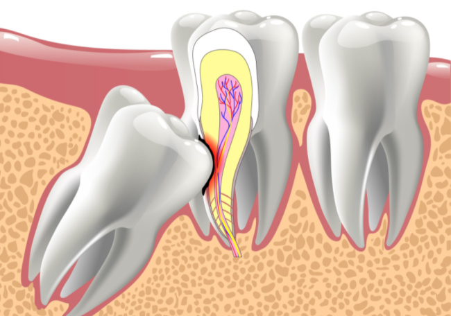 Preventing Damage to the Second Molar