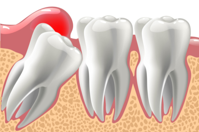 Wisdom Teeth