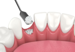 Bone Grafting