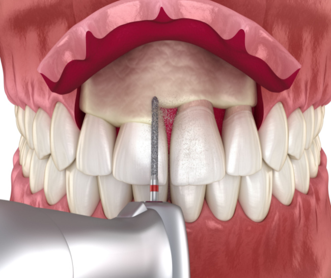 Crown Lengthening