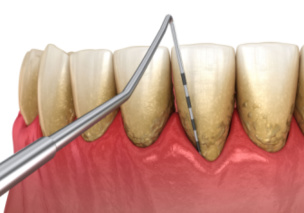 PERIODONTAL (GUM) THERAPY