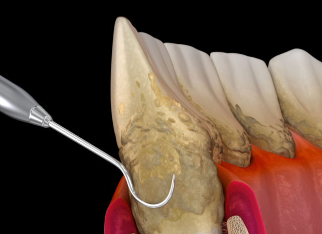 How is Periodontal Disease Caused?