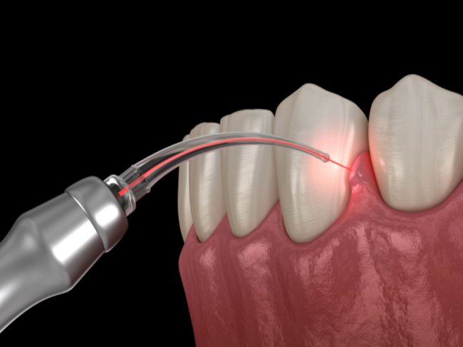 Laser Therapy