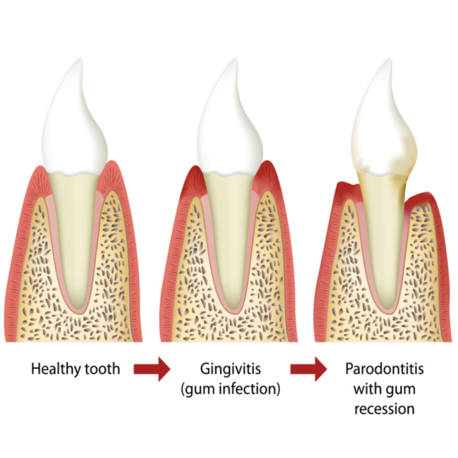 periodontitis