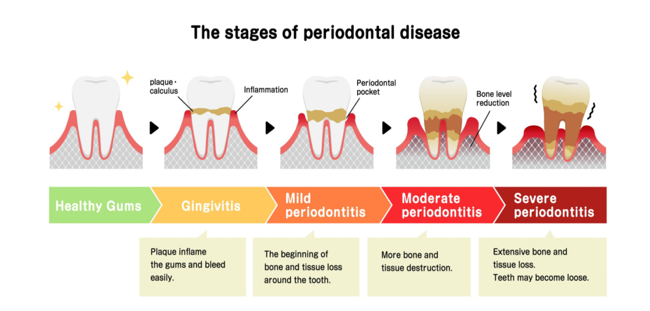 Stages and Symptoms of Periodontitis